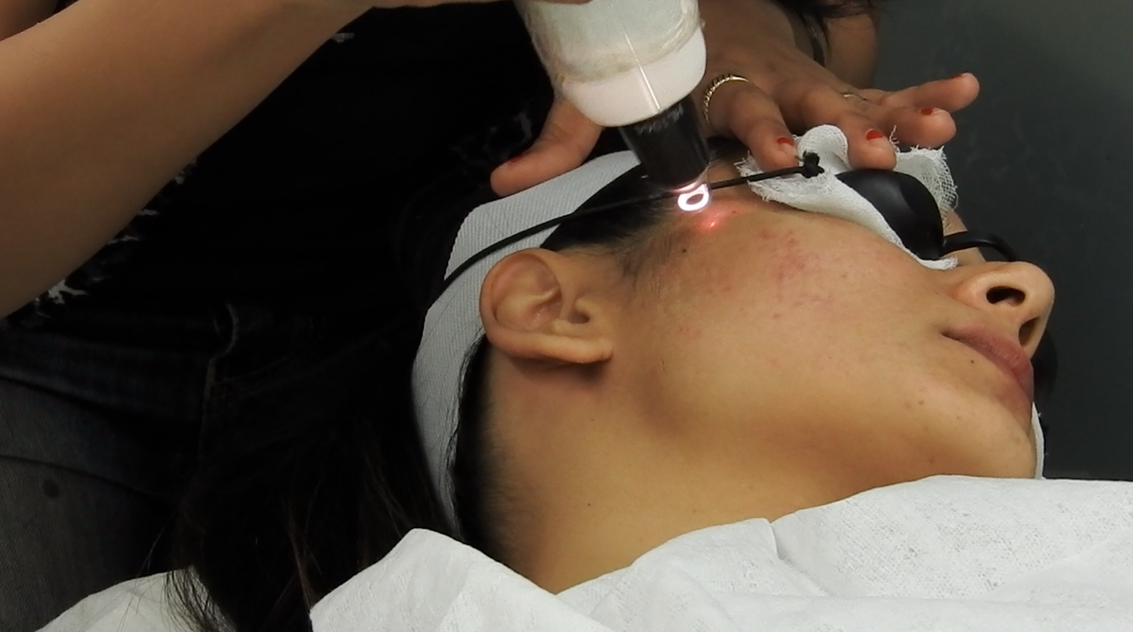Q Switch Laser Treatment