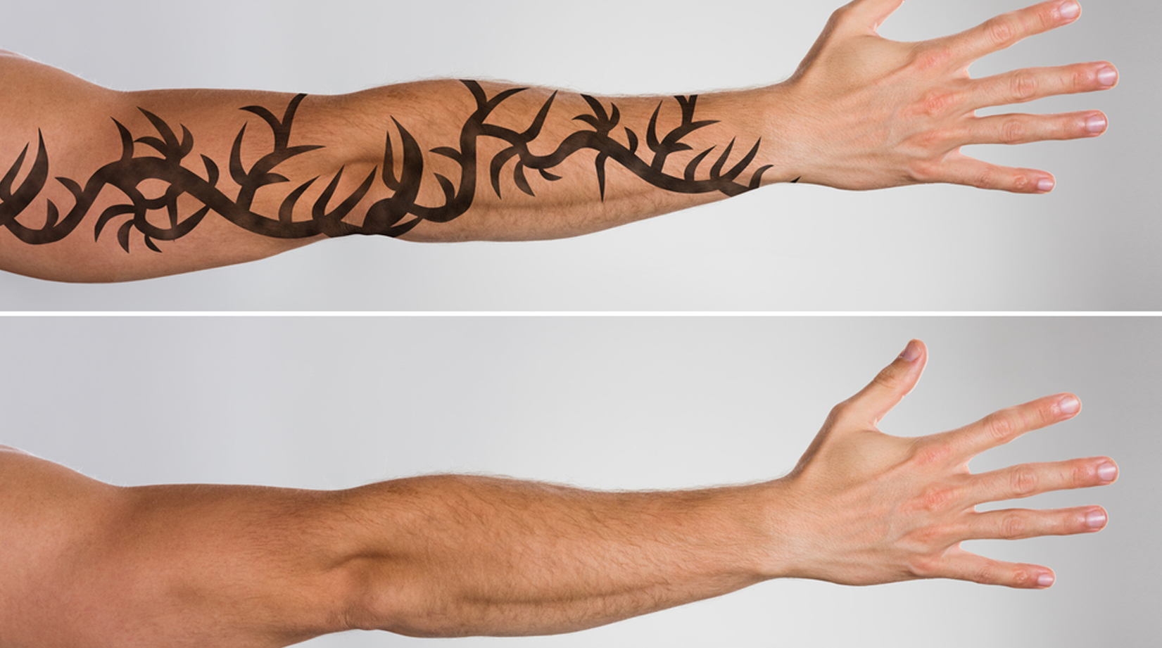 How Does Laser Tattoo Removal Work? | Metro Dermatology